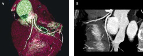 Prevalence of Congenital Coronary Artery Anomalies {faces}